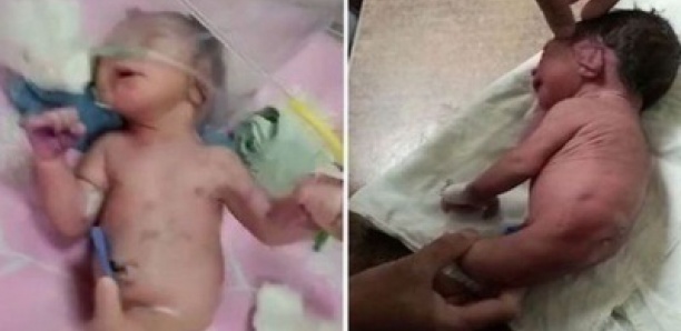 Un bébé né avec une corne étrange au lieu de jambes laisse les médecins perplexes￼